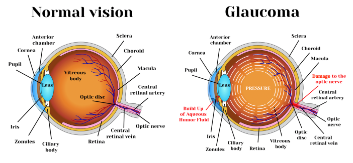 Diagram of an eye (normal vision vs. glaucoma)