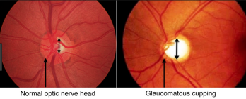 Image of what the doctor sees through the ophthalmoscope