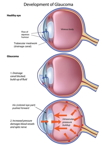 Image of the development of glaucoma and trabecular meshwork