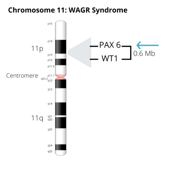 Image of Chromosome 11, including .6 Mb deletion that includes the PAX 6 and WT1 genes (arrow pointing to PAX 6)