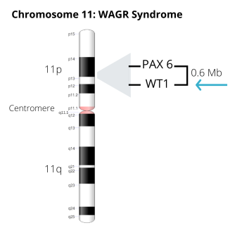 Image of Chromosome 11, including .6 Mb deletion that includes the PAX 6 and WT1 genes (arrow pointing to WT1 gene)