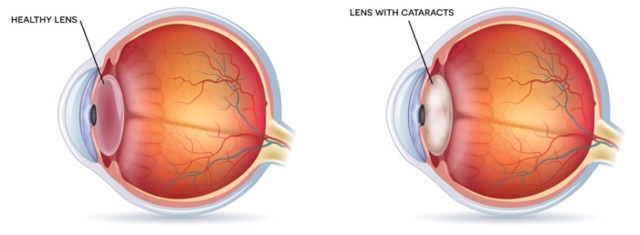Image of healthy lens and lens with cataract