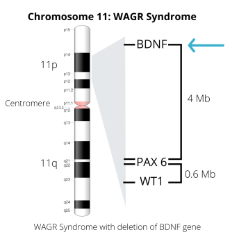 Image of Chromosome 11, including deletion of the BDNF gene
