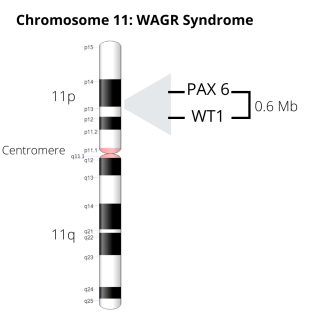 Image of Chromosome 11, including .6 Mb deletion that includes the PAX 6 and WT1 genes