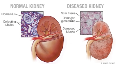 Image of normal vs. diseased kidney