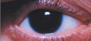 Image of Aniridic Eye