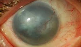 Aniridic Keratopathy